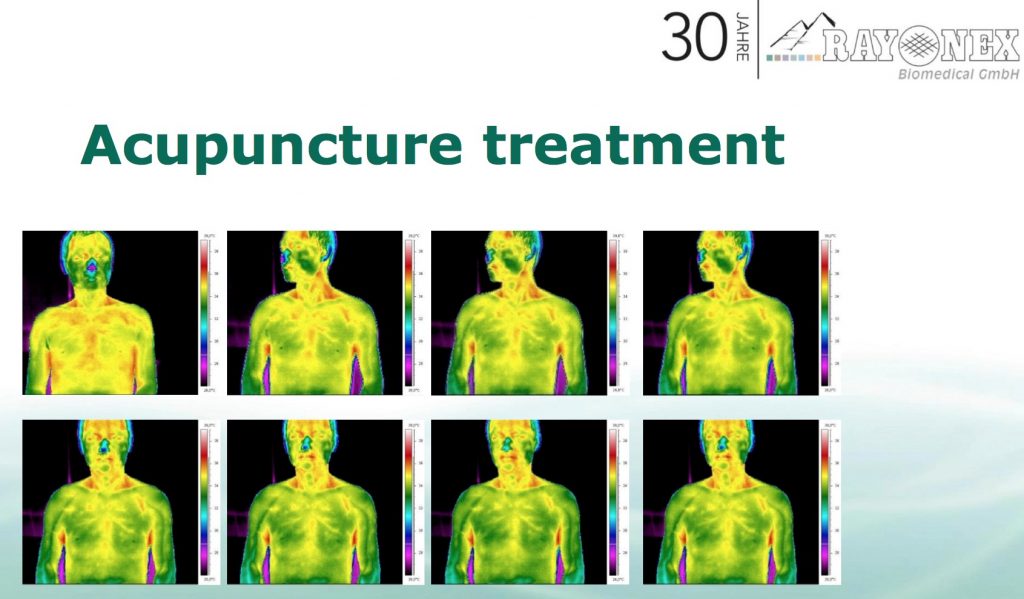 Thermo Imaging - 正接受生物共振調理肺經的人士的身體反應